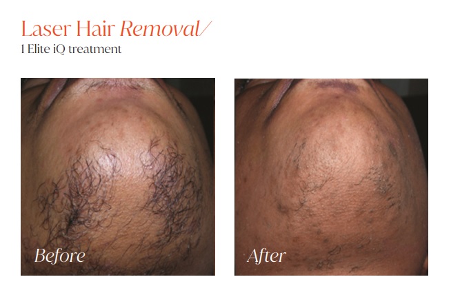 Laser Hair Removal 3